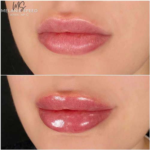 Lip Augmentation Before & After Photos by Flawless Medspa in Las Vegas NV