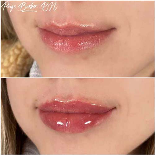 Lip Augmentation Before & After Photos by Flawless Medspa in Las Vegas NV