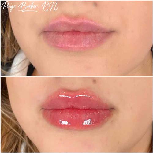 Lip Augmentation Before & After Photos by Flawless Medspa in Las Vegas NV