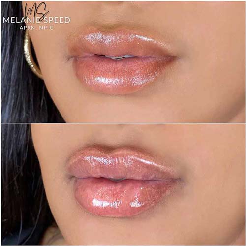 Lip Augmentation Before & After Photos by Flawless Medspa in Las Vegas NV