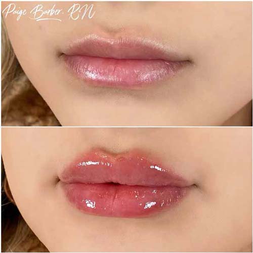 Lip Augmentation Before & After Photos by Flawless Medspa in Las Vegas NV