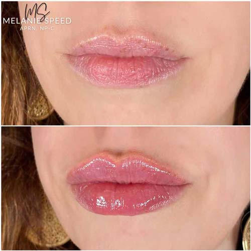 Lip Augmentation Before & After Photos by Flawless Medspa in Las Vegas NV