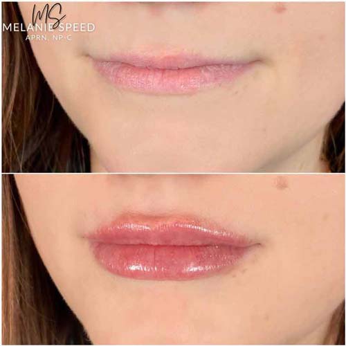 Lip Augmentation Before & After Photos by Flawless Medspa in Las Vegas NV