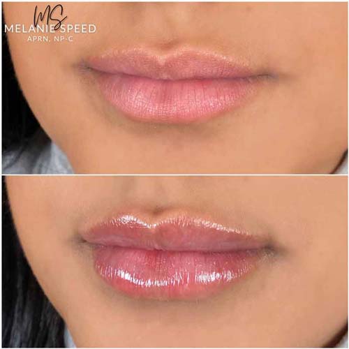 Lip Augmentation Before & After Photos by Flawless Medspa in Las Vegas NV