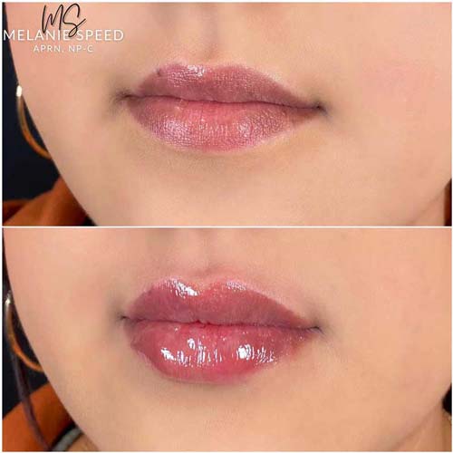 Lip Augmentation Before & After Photos by Flawless Medspa in Las Vegas NV