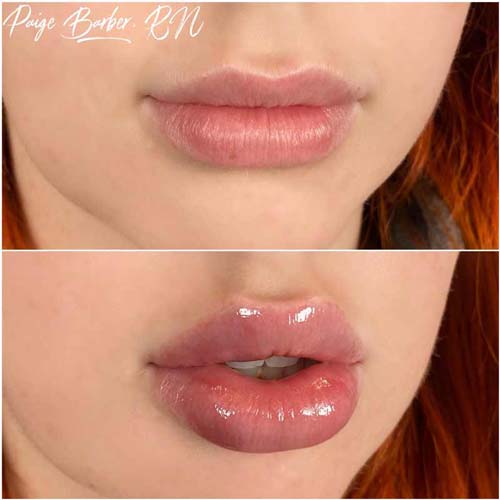 Lip Augmentation Before & After Photos by Flawless Medspa in Las Vegas NV