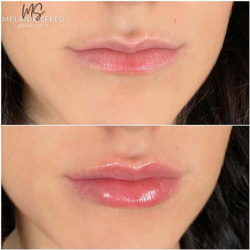 Lip Augmentation Before & After Photos by Flawless Medspa in Las Vegas NV