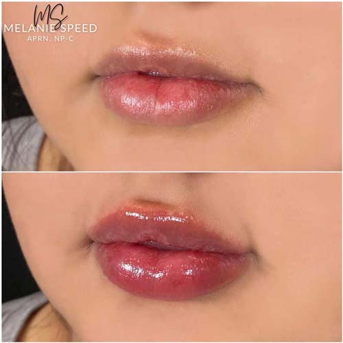 Lip Augmentation Before & After Photos by Flawless Medspa in Las Vegas NV