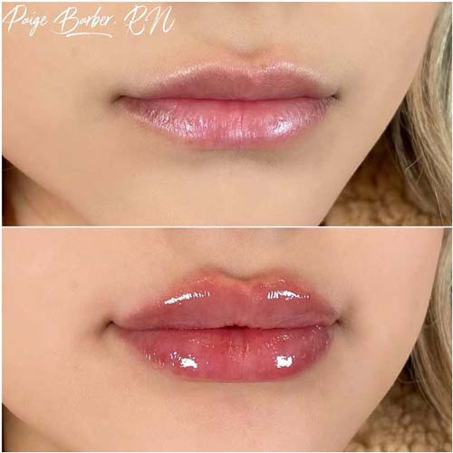 Lip Augmentation Before & After Photos by Flawless Medspa in Las Vegas NV