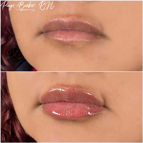 Lip Augmentation Before & After Photos by Flawless Medspa in Las Vegas NV