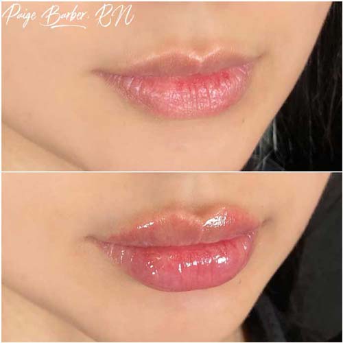 Lip Augmentation Before & After Photos by Flawless Medspa in Las Vegas NV