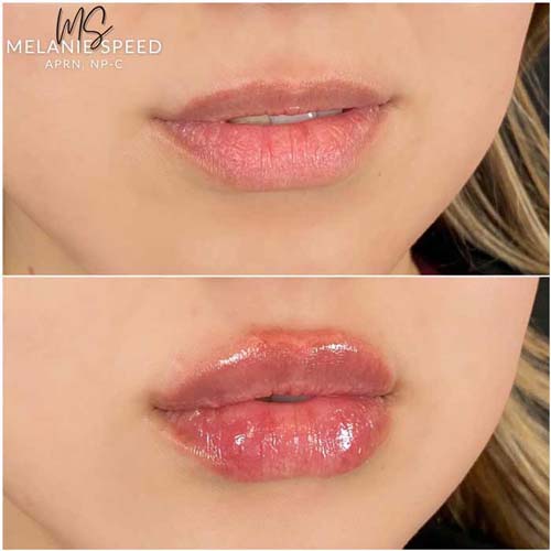 Lip Augmentation Before & After Photos by Flawless Medspa in Las Vegas NV