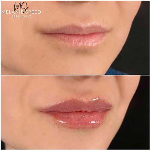 Lip Augmentation Before & After Photos by Flawless Medspa in Las Vegas NV