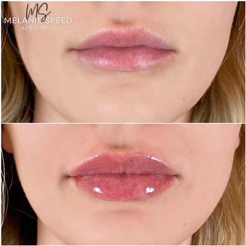 Lip Augmentation Before & After Photos by Flawless Medspa in Las Vegas NV