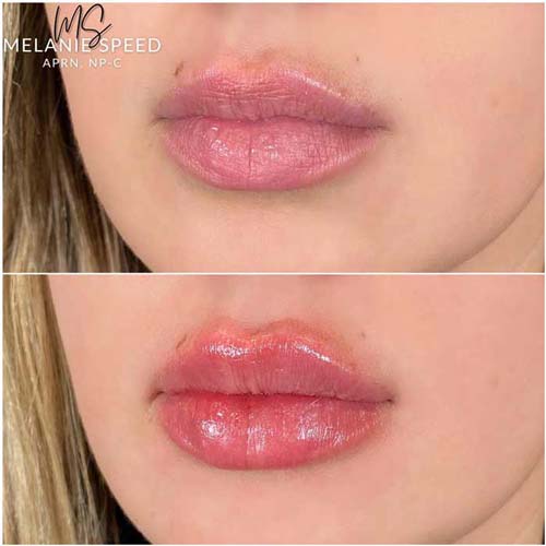 Lip Augmentation Before & After Photos by Flawless Medspa in Las Vegas NV