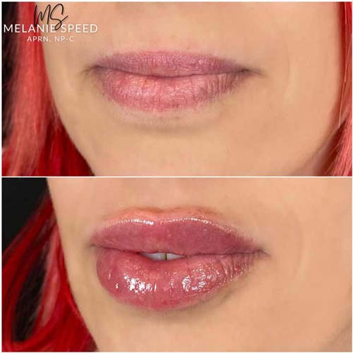 Lip Augmentation Before & After Photos by Flawless Medspa in Las Vegas NV