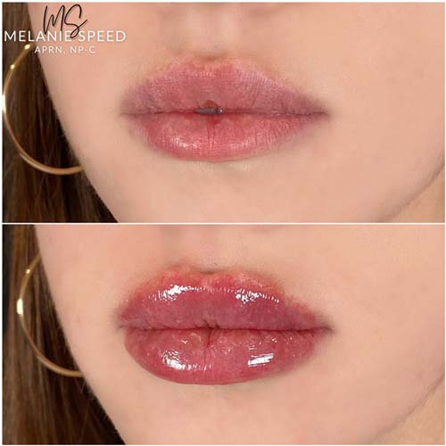 Lip Augmentation Before & After Photos by Flawless Medspa in Las Vegas NV