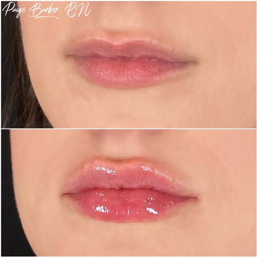 Lip Augmentation Before & After Photos by Flawless Medspa in Las Vegas NV