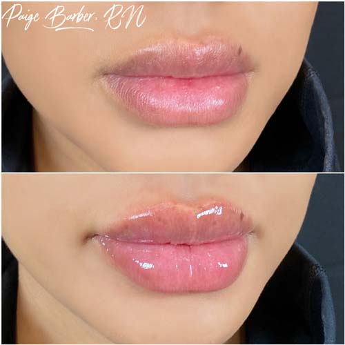 Lip Augmentation Before & After Photos by Flawless Medspa in Las Vegas NV