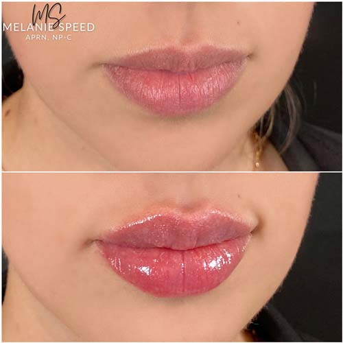 Lip Augmentation Before & After Photos by Flawless Medspa in Las Vegas NV