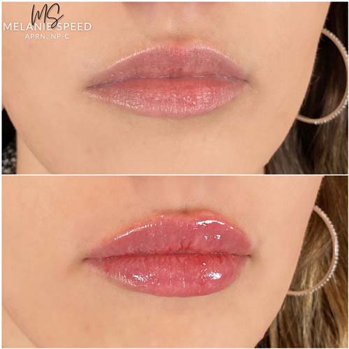 Lip Augmentation Before & After Photos by Flawless Medspa in Las Vegas NV