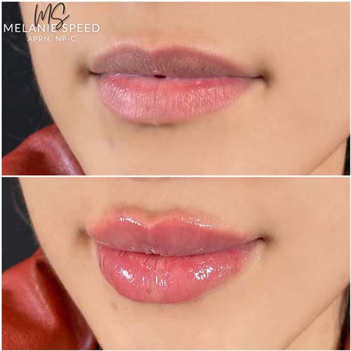 Lip Augmentation Before & After Photos by Flawless Medspa in Las Vegas NV