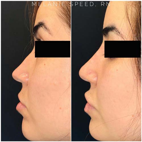 Nose Correction by Flawless Medspa