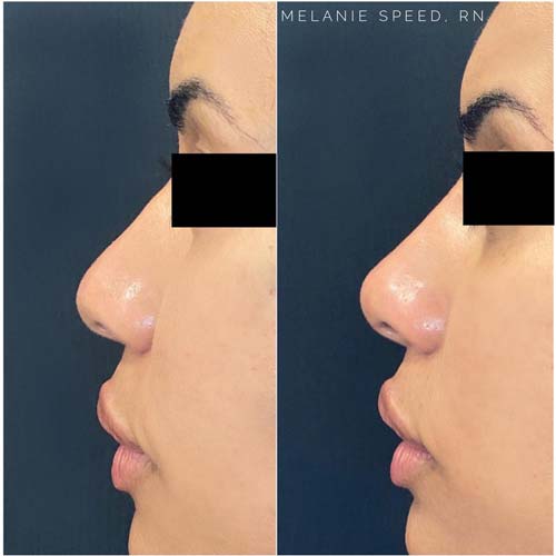 Nose Correction by Flawless Medspa