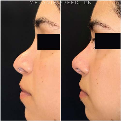 Nose Correction by Flawless Medspa