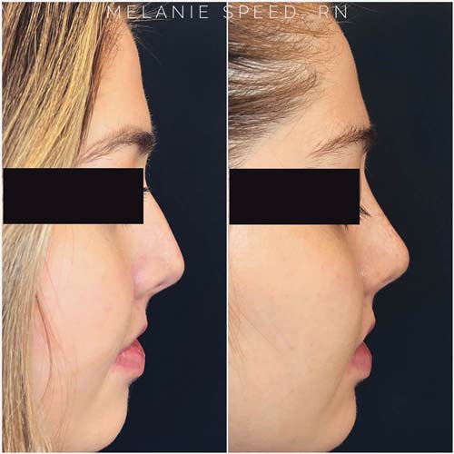 Nose Correction by Flawless Medspa