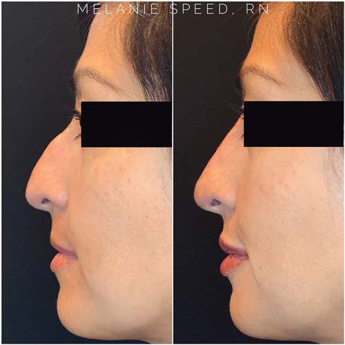 Nose Correction by Flawless Medspa