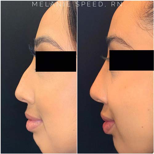 Nose Correction by Flawless Medspa