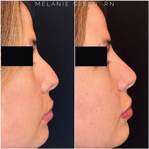 Nose Correction by Flawless Medspa