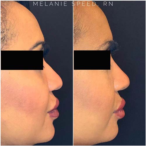 Nose Correction by Flawless Medspa