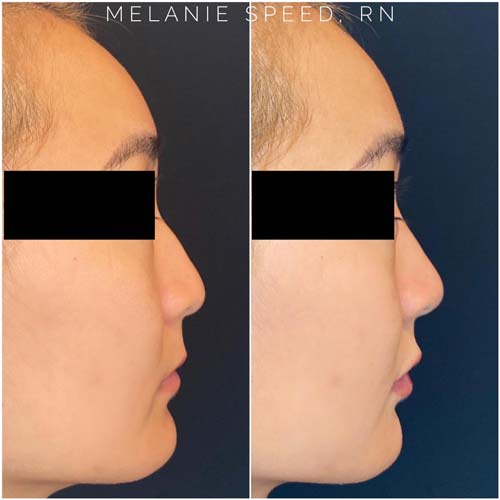 Nose Correction by Flawless Medspa