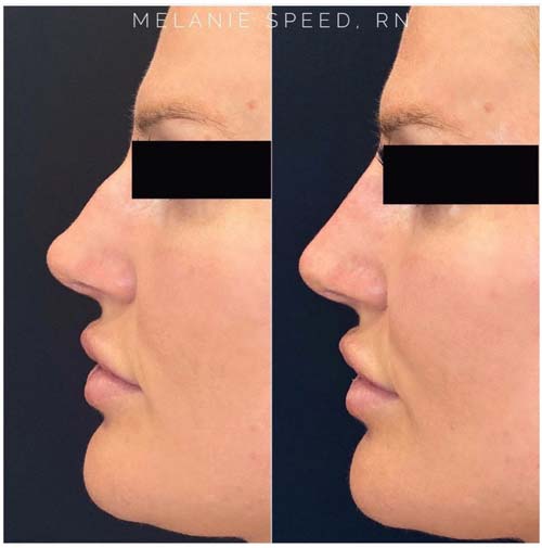 Nose Correction by Flawless Medspa