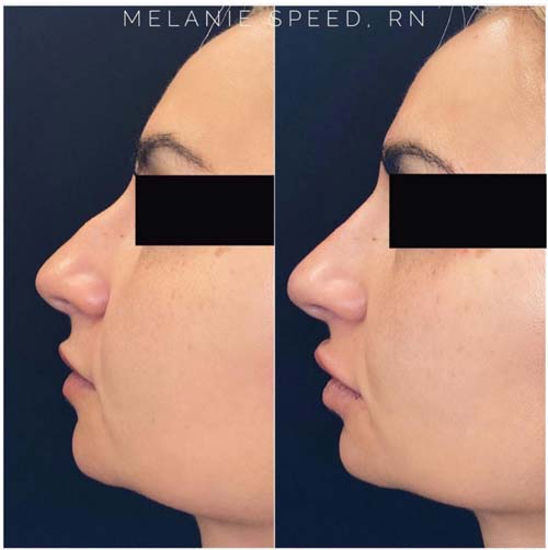 Non Surgical Nose Job Before and After at Flawless MedSpa & The Beverly Hills MedSpa in Beverly Hills, CA and Las Vegas, NV