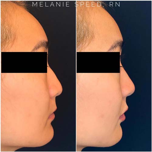 Nose Correction by Flawless Medspa