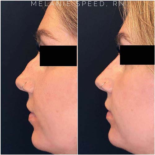 Nose Correction by Flawless Medspa