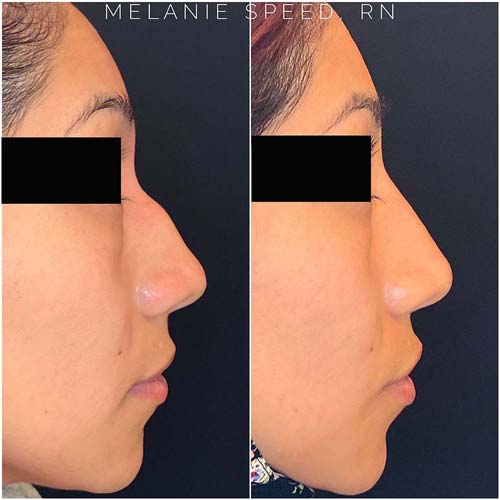 Nose Correction by Flawless Medspa