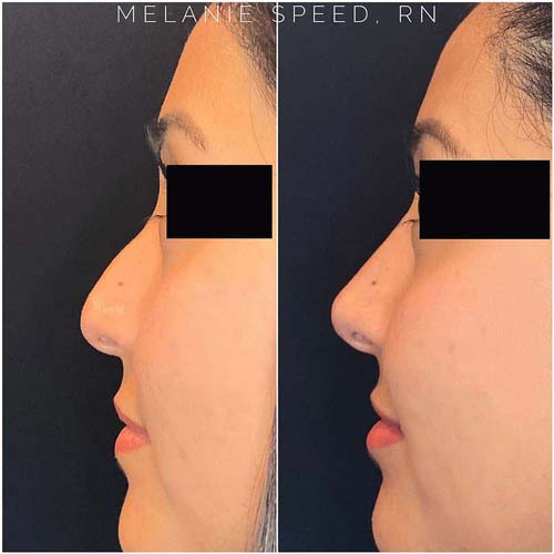 Non Surgical Nose Job Before and After at Flawless MedSpa & The Beverly Hills MedSpa in Beverly Hills, CA and Las Vegas, NV