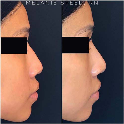 Nose Correction by Flawless Medspa