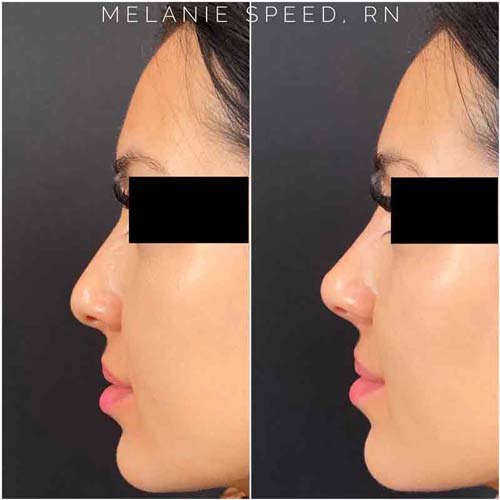 Nose Correction by Flawless Medspa