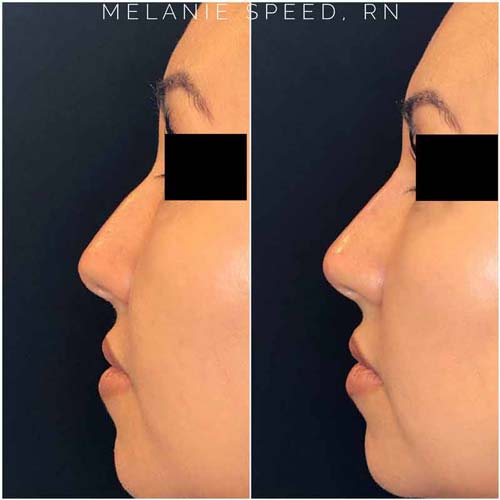 Nose Correction by Flawless Medspa