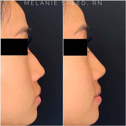 Nose Correction by Flawless Medspa