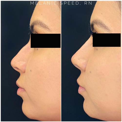 Nose Correction by Flawless Medspa