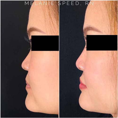 Nose Correction by Flawless Medspa