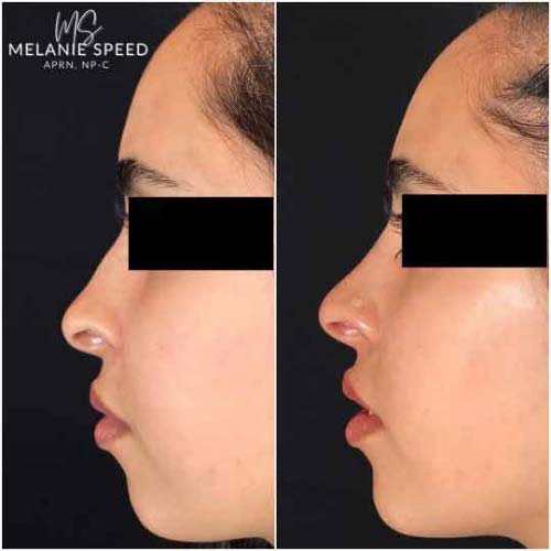 Nose Correction by Flawless Medspa