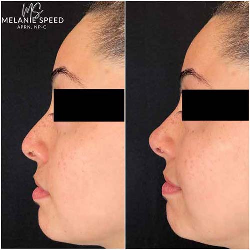 Non Surgical Nose Job Before and After at Flawless MedSpa & The Beverly Hills MedSpa in Beverly Hills, CA and Las Vegas, NV