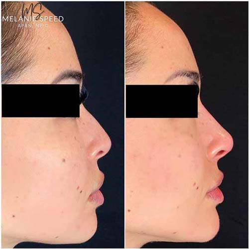 Nose Correction by Flawless Medspa